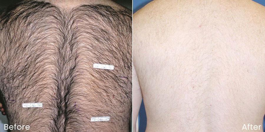 Man's back before and after laser hair removal showing a lot of hair before and a smooth, hairless back after