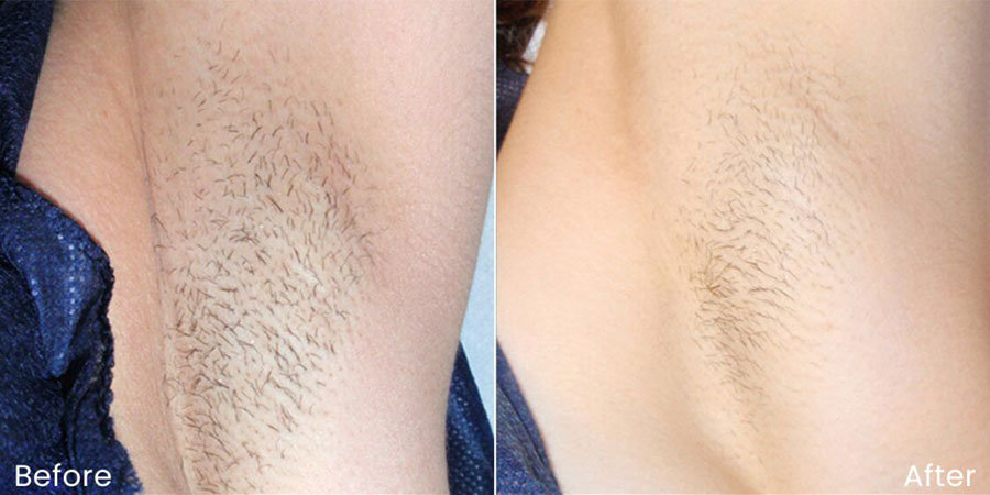 Armpit before and after laser hair removal showing a hairy armpit before and a smooth, hairless armpit after