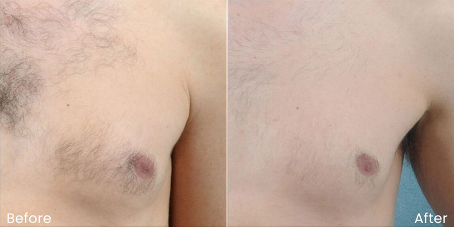 Man's chest before and after laser hair removal showing hair on the chest before and much less hair after