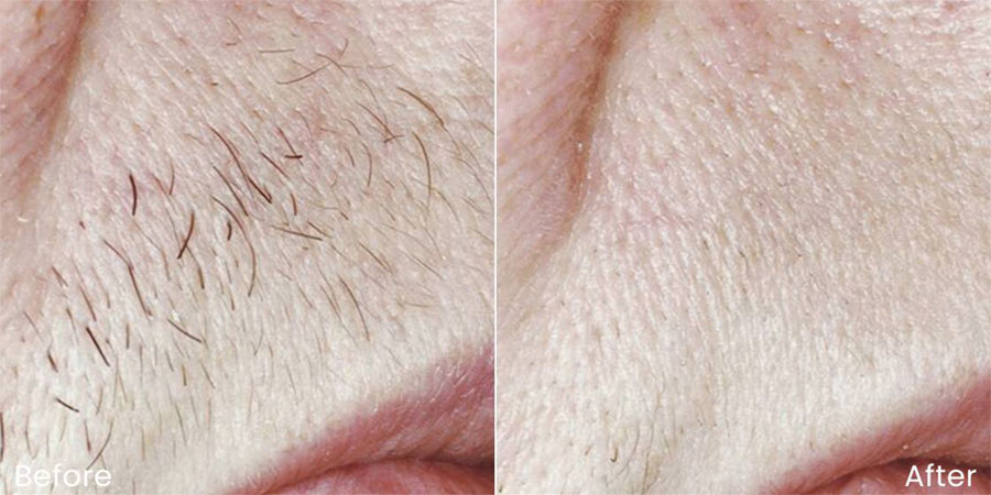 Woman's lip before and after laser hair removal treatment showing thick hair growth before and smooth, hairless skin after