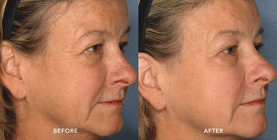 Woman's face showing smoother, clearer skin in before and after photos for Picosure treatment