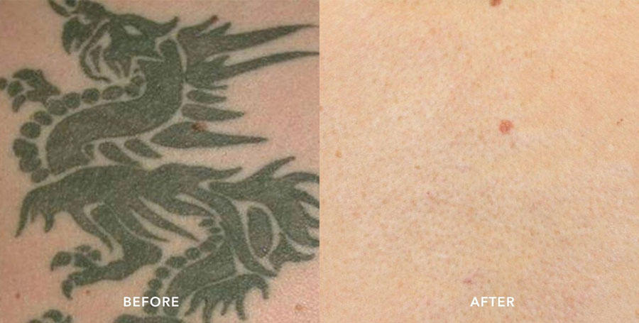 Before and after photo of tattoo removal by Picosure