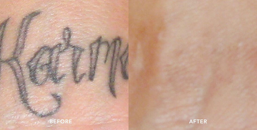 Before and after photos of tattoo removal by Picosure