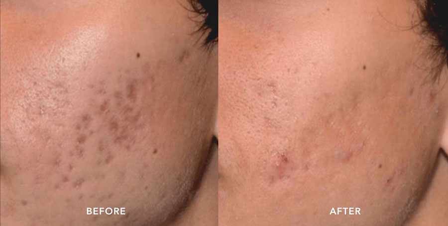 Man's cheek showing improvement in appearance of acne scars in before and after photos for Picosure treatment