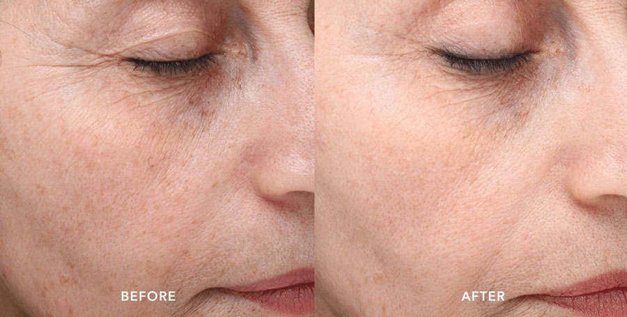 Woman's face showing improvement in age spots and discoloration in before and after photos for Picosure