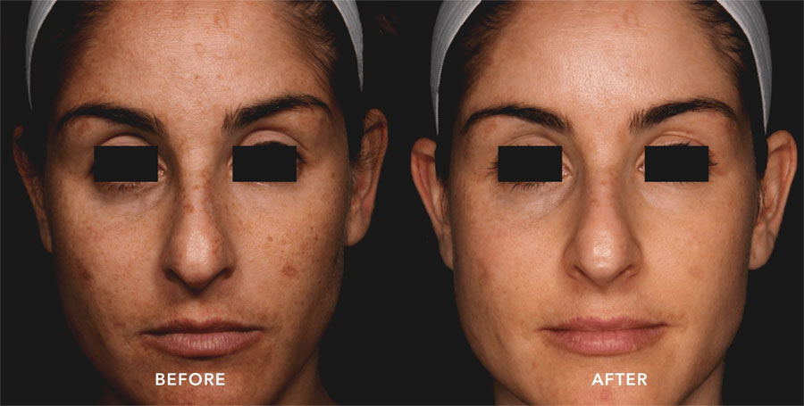 Woman's face showing brighter skin with improvement in age spots and discoloration in before and after photos for Picosure