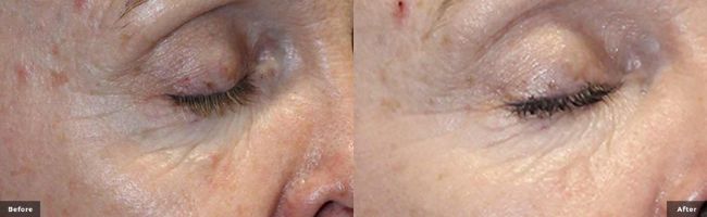 Woman's eyes showing smoother, younger looking skin in before and after treatments for RF Microneedling with Potenza