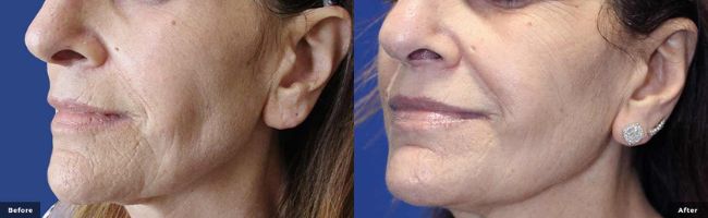 Woman's face and lip area showing smoother, younger-looking skin in before and after photos for RF Microneedling with Potenza