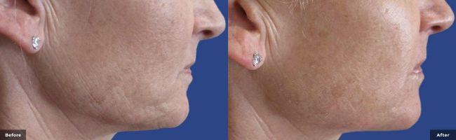 Woman's cheek showing reduced signs of aging in before and after photos for RF Microneedling with Potenza