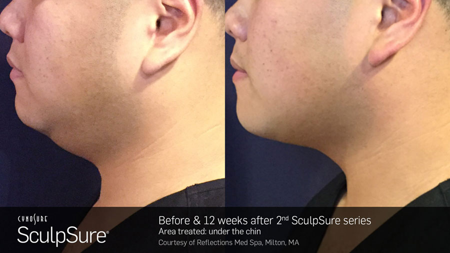 Man's chin and neck area showing reduction in fat in before and after photos for Sculpsure treatment
