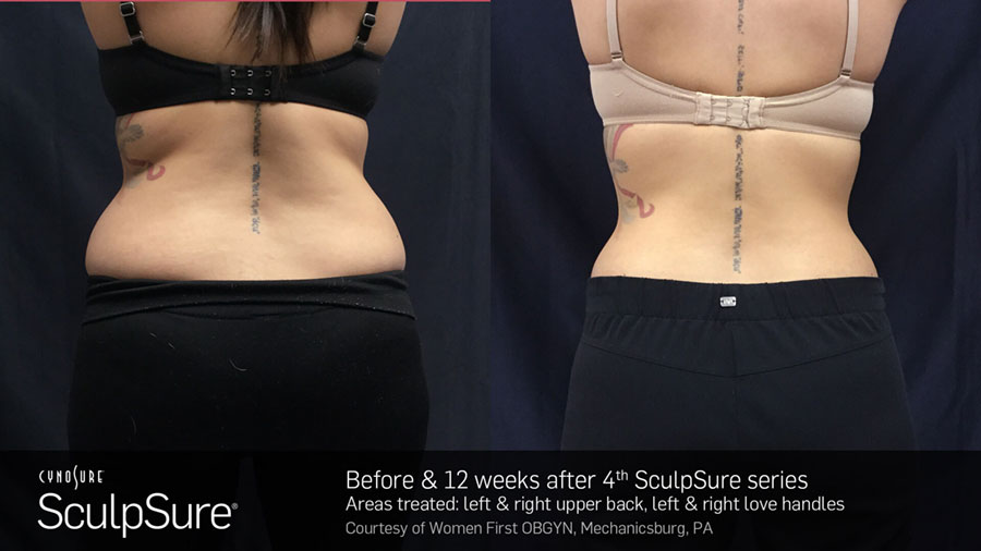 Woman's back area showing reduction in fat and smoother, more toned physique in before and after photos for Sculpsure treatment