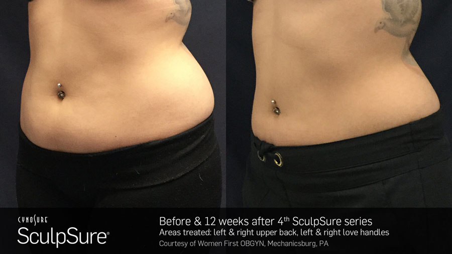 Woman's abdomen showing reduction in fat in before and after photos for Sculpsure treatment