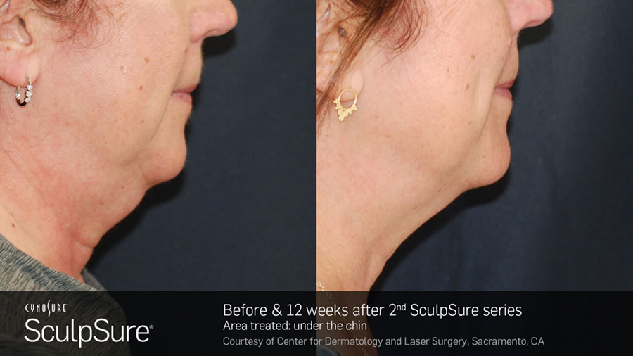 Woman's neck area showing a reduction in fat in before and after photos for Sculpsure treatment