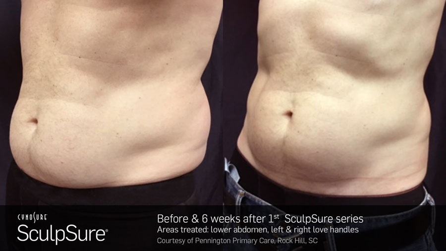 Man's abdomen showing reduction in fat and a more toned physique in before and after photos for Sculpsure treatment