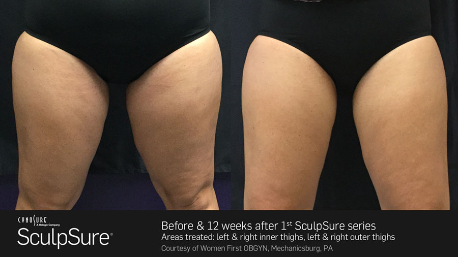 Woman's thighs showing a reduction in fat in before and after photos for Sculpsure treatment