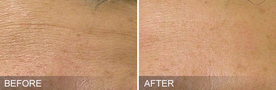 Woman's forehead showing fine lines and wrinkles before and after Hydrafacial treatment