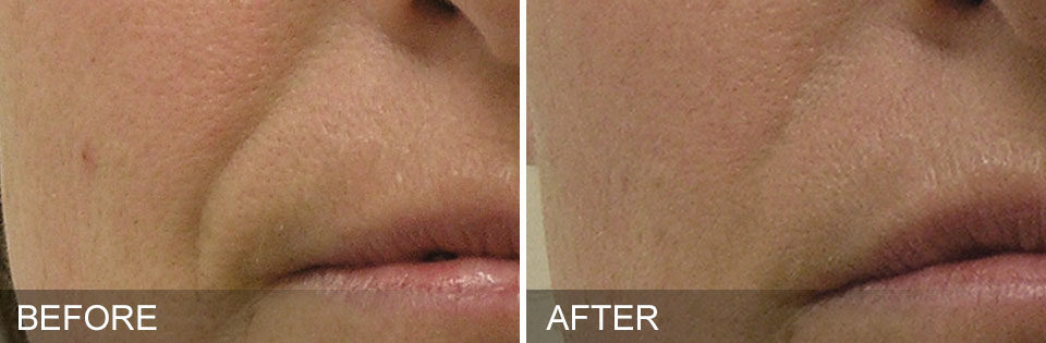 Lips showing less fine lines and wrinkle before and after Hydrafacial treatment