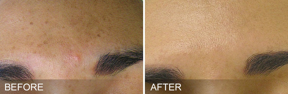 Woman's forehead showing smoother, clearer skin before and after Hydrafacial treatment