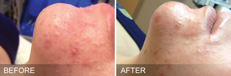 Woman's chin showing less redness and improvement in acne before and after Hydrafacial treatment