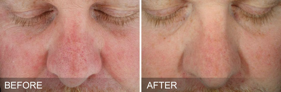Man's nose showing less redness and clearer skin before and after Hydrafacial treatment