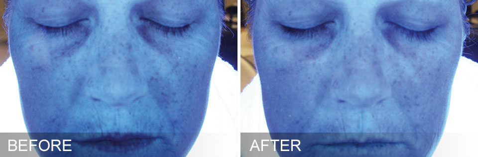 Woman's face showing less fine lines and wrinkles and less sun damage before and after photos for Hydrafacial treatment