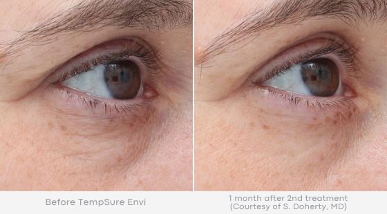 Woman's eye with minimized fine lines and wrinkles in before and after photos for Tempsure treatment
