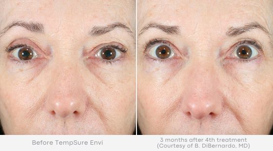 Woman's eyes with minimized fine lines and wrinkles in before and after photos for Tempsure treatment