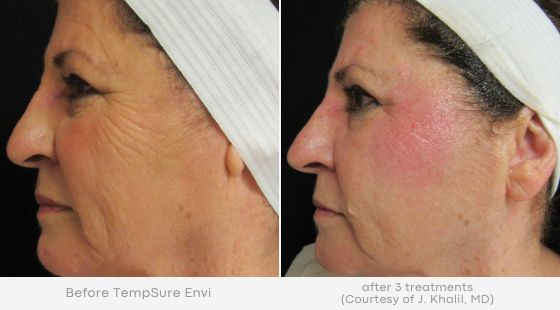 Woman's cheeks showing tighter, smoother skin in before and after photos for Tempsure treatment