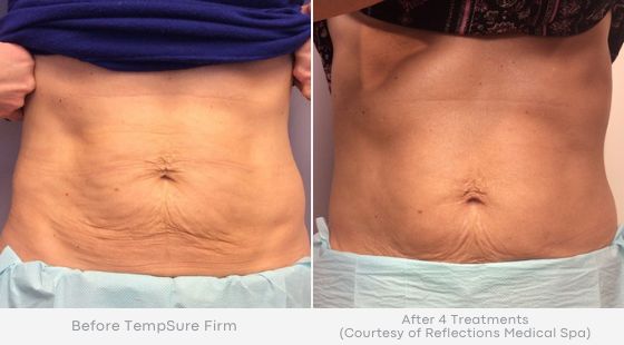 Woman's abdomen showing tighter, smoother skin in before and after photos for Tempsure treatment