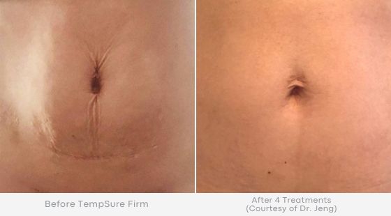Woman's abdomen showing smoother, tighter skin in before and after photos for Tempsure treatment