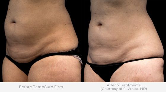 Woman's abdomen area showing smoother, tighter skin in before and after photos for Tempsure treatment