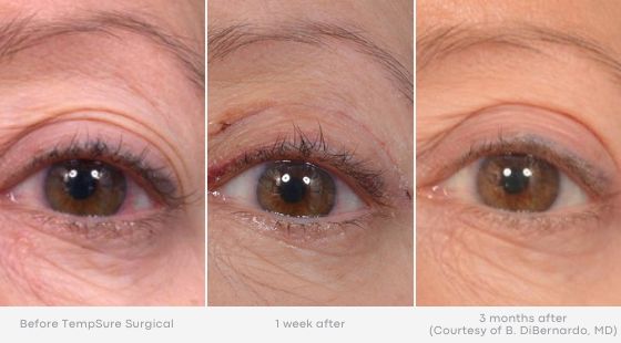 Woman's eye showing minimized fine lines and wrinkles in before and after photos for Tempsure treatment