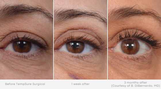Woman's eye with minimized fine lines and wrinkles in before and after photos for Tempsure treatment