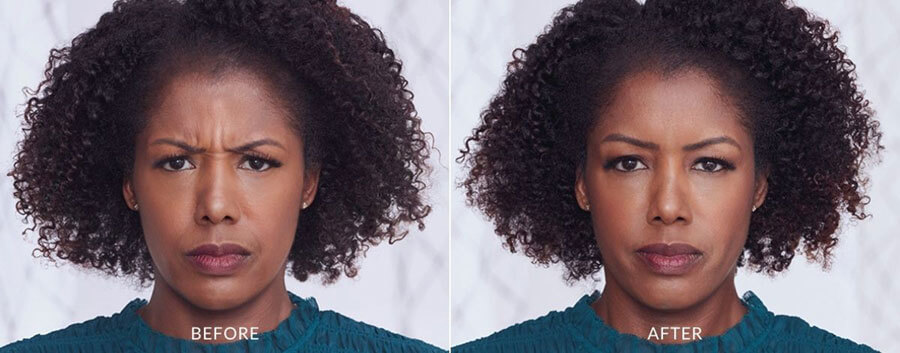 Black woman showing improvement in fine lines and wrinkles after Botox treatment