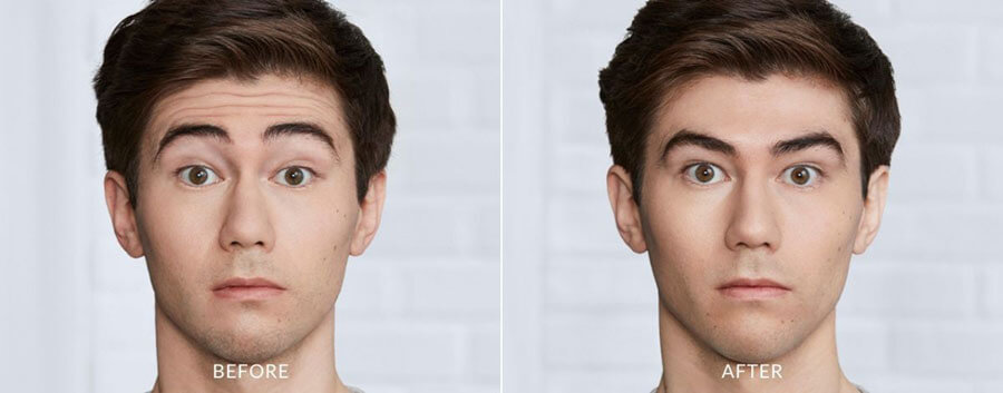 Handsome man showing minimized fine lines and wrinkles in before and after photos after Botox treatment.