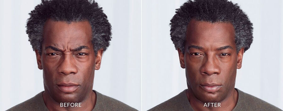 Older black man showing before and after results with improvement in appearance of fine lines and wrinkles after Botox treatment