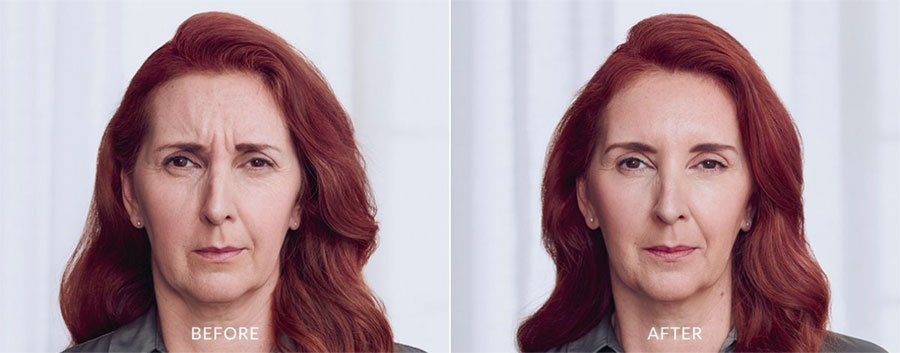 Red headed woman showing improvement in the appearance of fine lines and wrinkles in before and after photos after Botox treatment