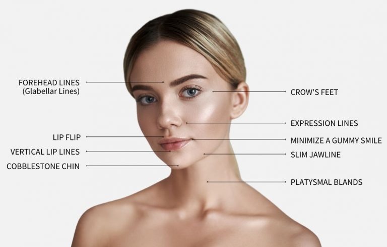 Graphic with beautiful woman with perfect skin showing the different treatment areas for Botox